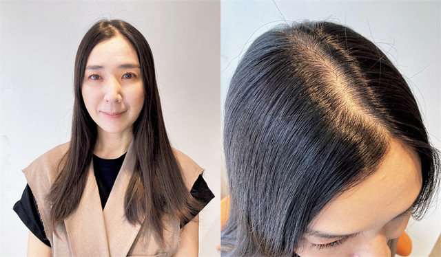 40岁女人头顶脱发严重怎么办,女人头顶有旋头发很少怎么处理