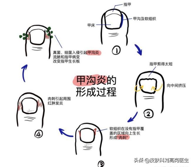 灰指甲引起的皮肤病怎么治疗,8种常见的灰指甲