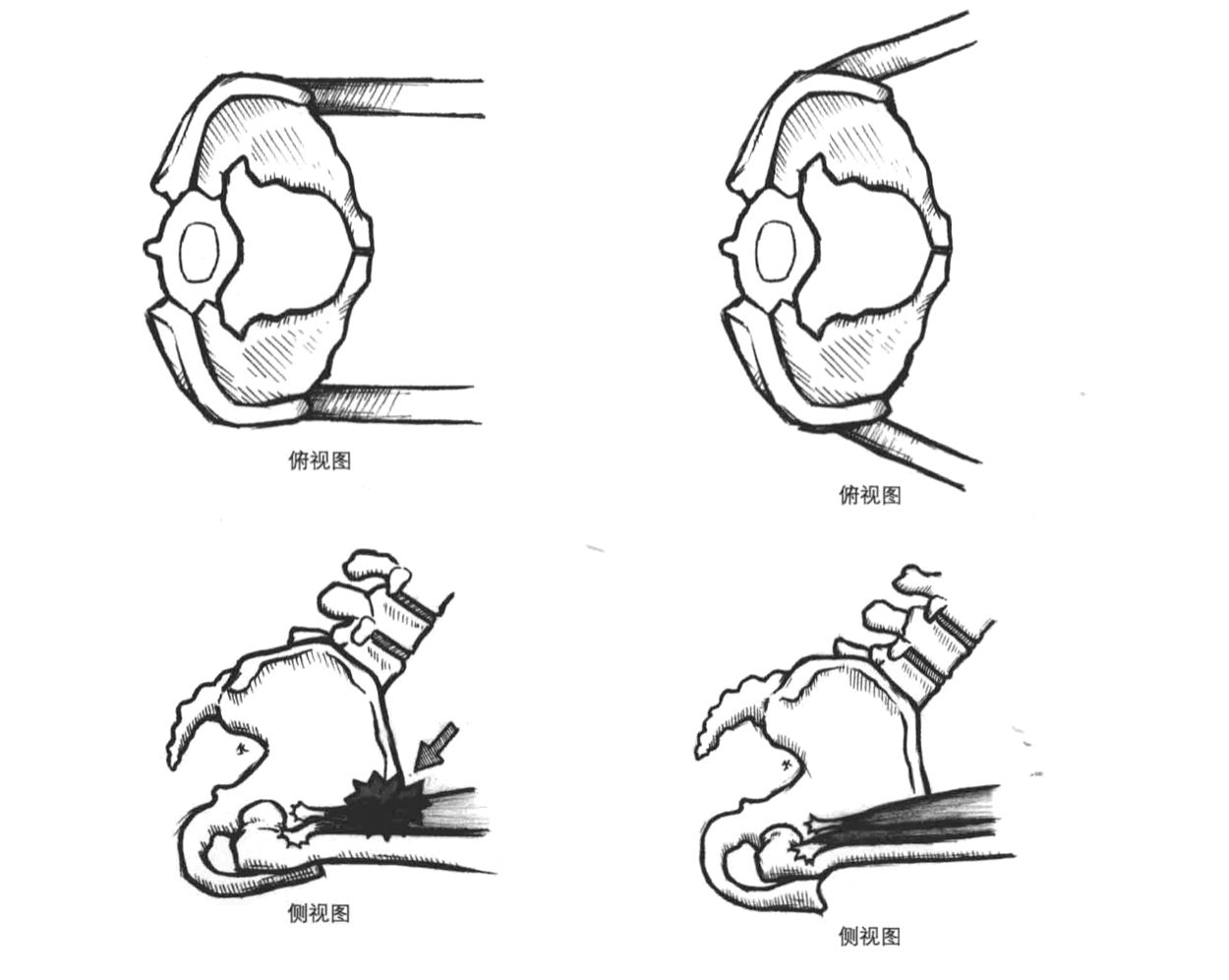 深蹲髋部发力图解,深蹲要求髋部内旋还是外旋