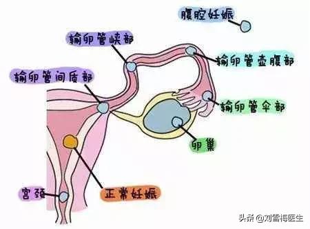 宫外孕怎么备孕防止再次宫外孕,得过宫外孕后要怎样备孕
