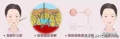 记录翻译小姐姐日本打溶脂针,肉脸变骨感脸全过程|日本医美