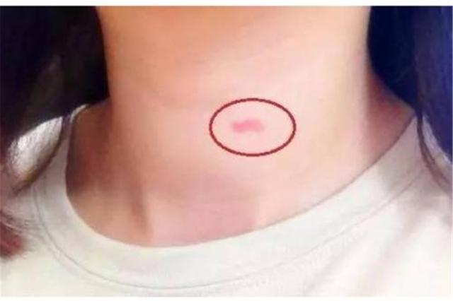 家长发现草莓印,孩子有草莓印