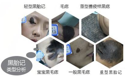 背上胎记长毛怎么回事,胎记长毛怎么处理