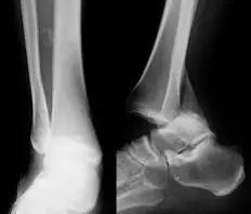 所有骨折都叫什么名字,骨折的名称有哪些