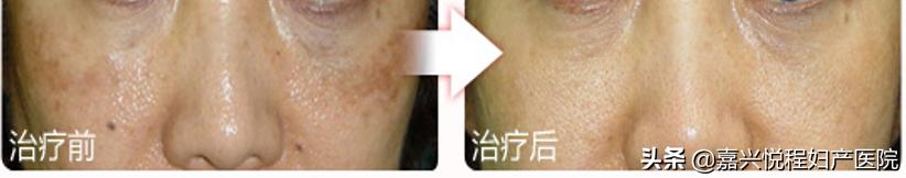 果酸是什么美容项目,能量果酸和果酸有什么区别