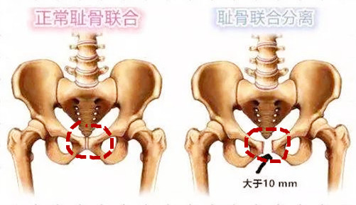 产后屁股大胯宽凹陷下垂怎么恢复,产后屁股又扁又大该怎么办