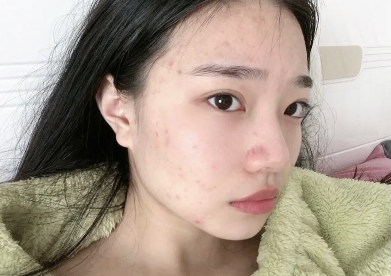 30岁之前不长痘30以后频繁长痘,30岁还一直长痘该怎么样护肤