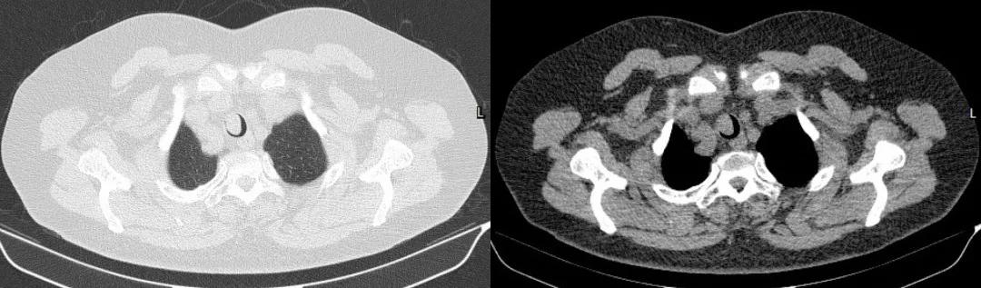 儿童90%为良性,成人却不到10%?患者气短3年,胸部CT提示的气管肿物意味着什么?气管镜有何发现?