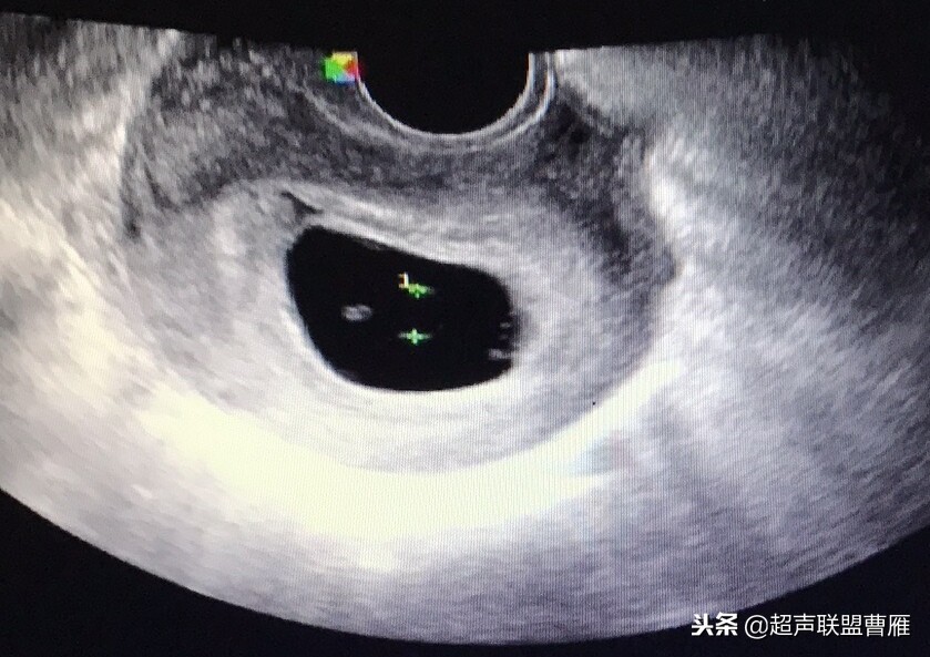 3毫米卵黄囊未见胎芽正常么,40多天的卵黄囊