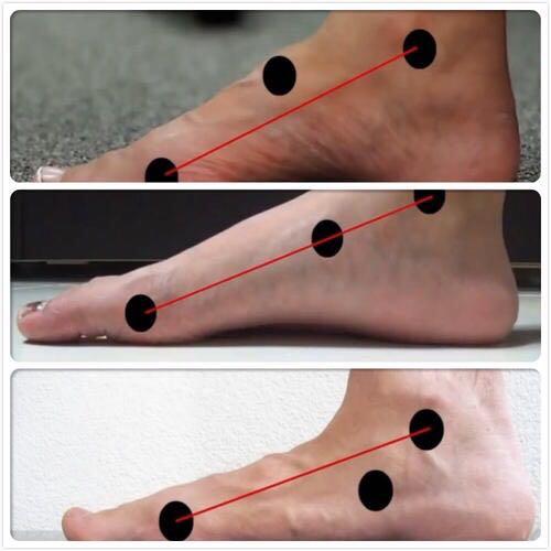 改善扁平足o型腿的训练方法,扁平足导致的膝超伸怎么改善