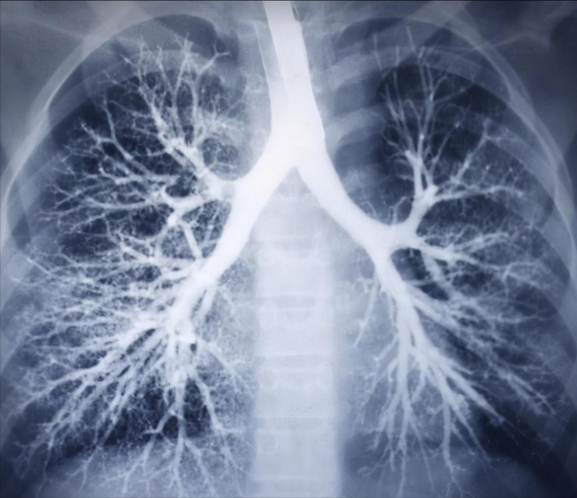 双肺纹理增粗是什么意思,两下肺纹理增多增粗紊乱