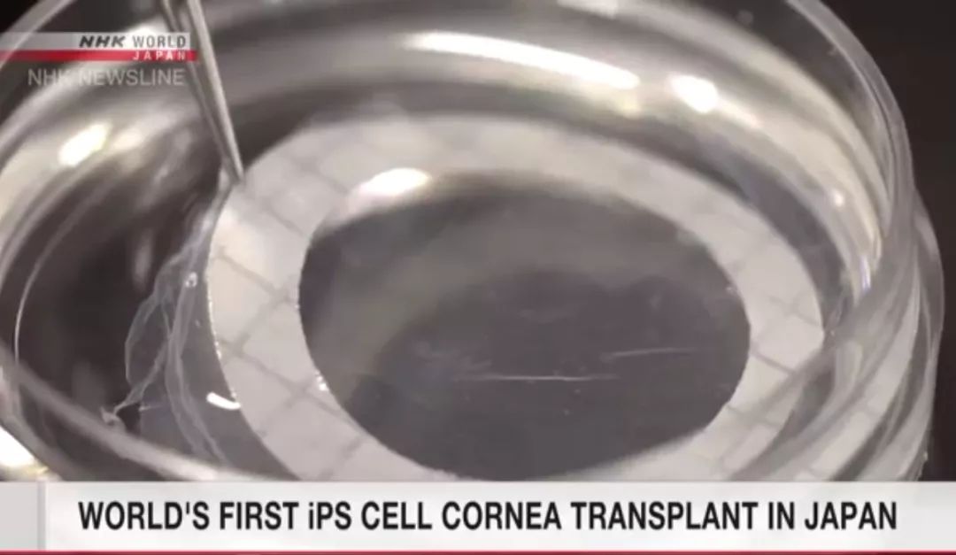 眼疾患者一大福音！全球首例iPS细胞培养角膜移植成功