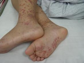 腹型过敏性紫癜的症状特点有哪些,腹型过敏性紫癜与普通腹痛的区别