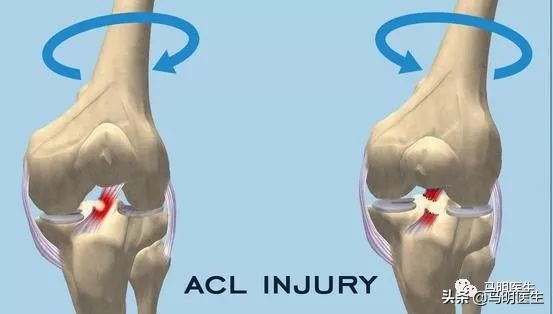 前交叉韧带损伤,ACLInjuries原因-双语学习