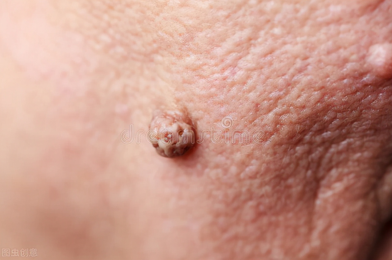 脖子和腋窝长小肉粒是什么原因,脖子和腋下长小肉粒会自己消失嘛