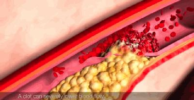 冠心病小红书——治疗的ABCDE