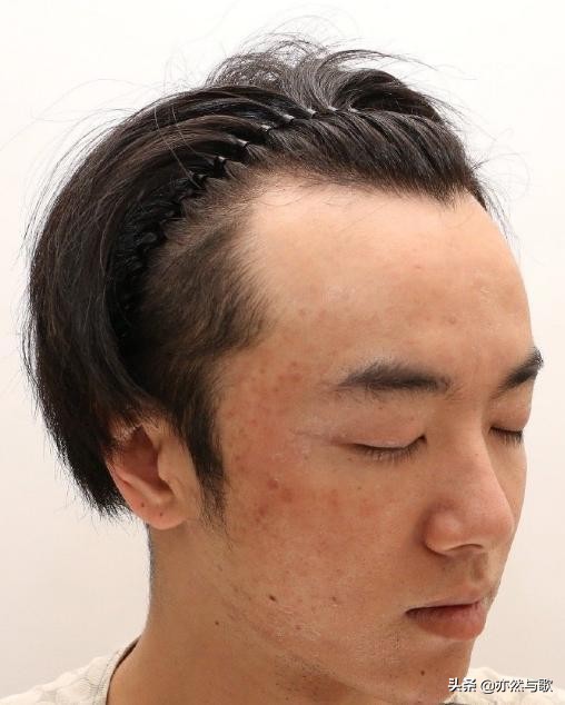 网友晒华晨宇私密视频，曝料其整容植发照，怒骂张碧晨是小三