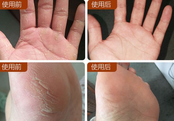手脚干裂倒刺怎么治疗,手脚经常脱皮开裂最佳治疗方法