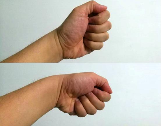 手指腱鞘炎的最佳治疗方法,拿手机导致腱鞘炎怎么办