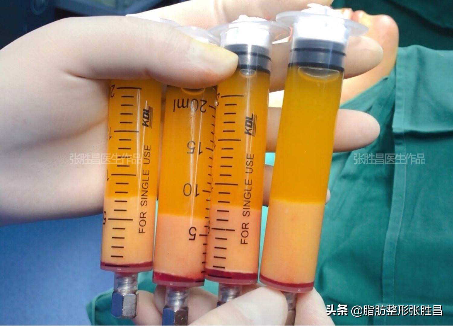 大腿环吸多久可以瘦腿,大腿环吸手术能穿内裤么