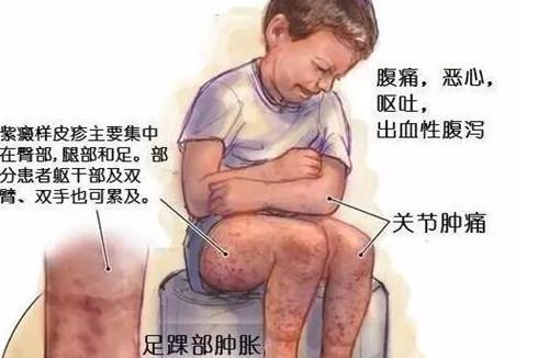 过敏性紫癜肾炎饮食上注意什么,吸入性的过敏性紫癜要注意什么