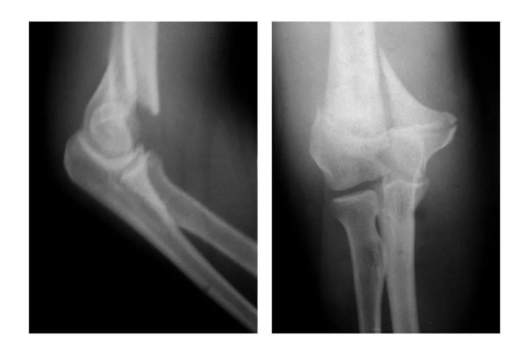 青少年肘部损伤最常见的是,肘部桡神经损伤的临床表现