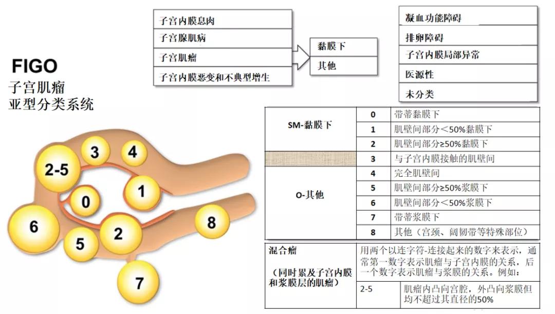 子宫肌瘤的诊治指南和专家共识,2018子宫肌瘤治疗指南