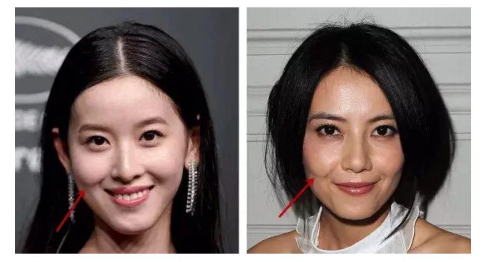 少年法令纹和痘坑显老,显老元凶法令纹