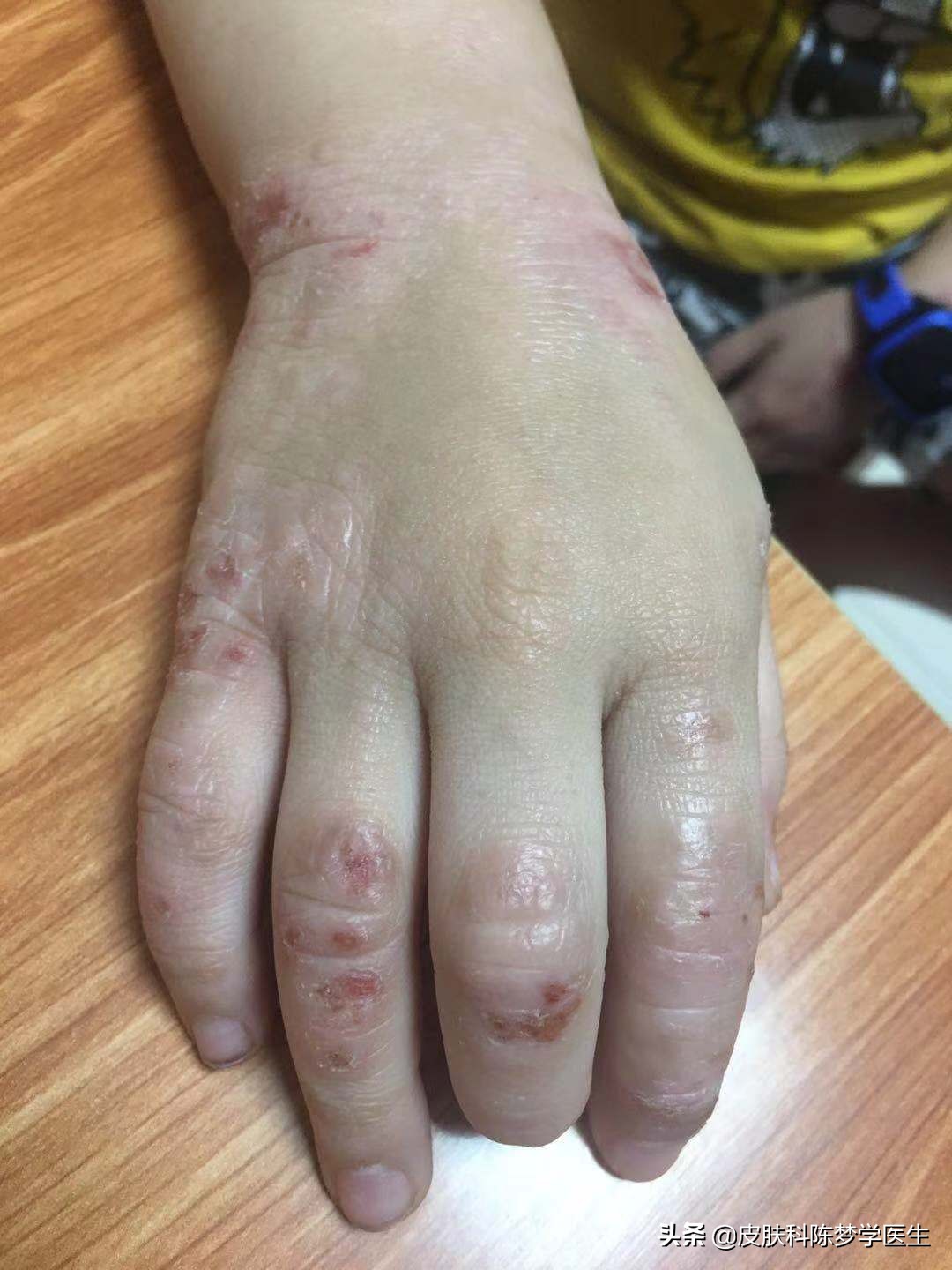 硫磺软膏能不能治湿疹,除湿止痒软膏能不能治湿疹