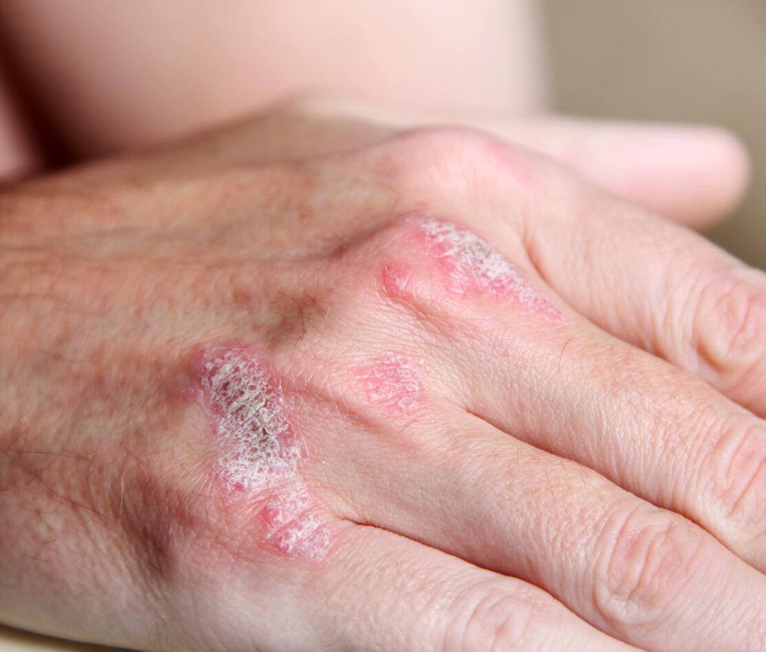 皮肤干燥是出现了什么问题,脸部皮肤干燥脱皮是什么原因