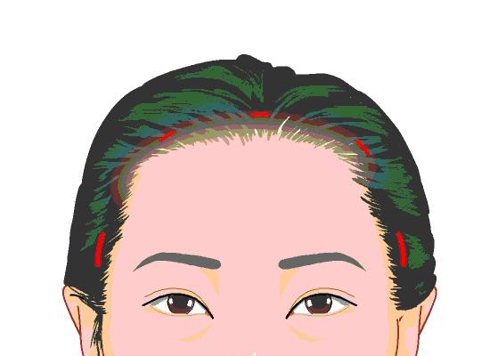 眼皮耷拉除了提眉还有什么办法,眼皮松弛下垂想提眉是需要动刀不