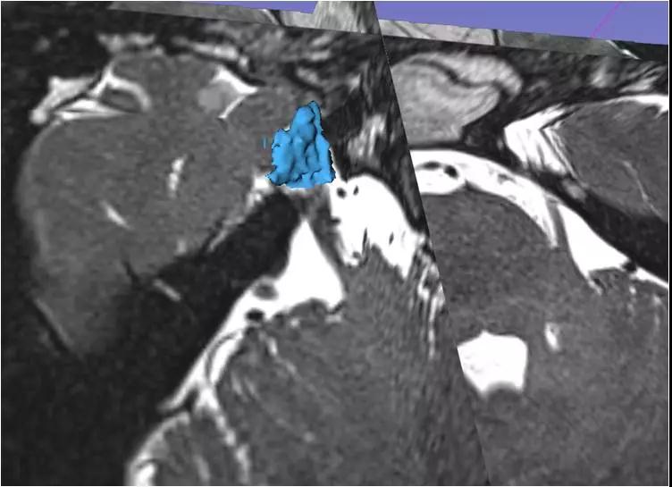 新年将近,ROSA机器人捷报再传!——精准微创小球囊,征服“天下第一痛”