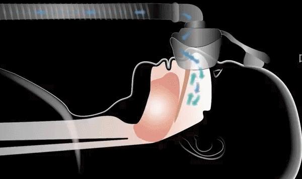 睡眠呼吸机治疗打鼾需要佩戴多久,睡眠呼吸机治疗打鼾吗