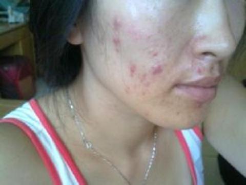 皇家雨燕教你痘痘肌の正确保养方式