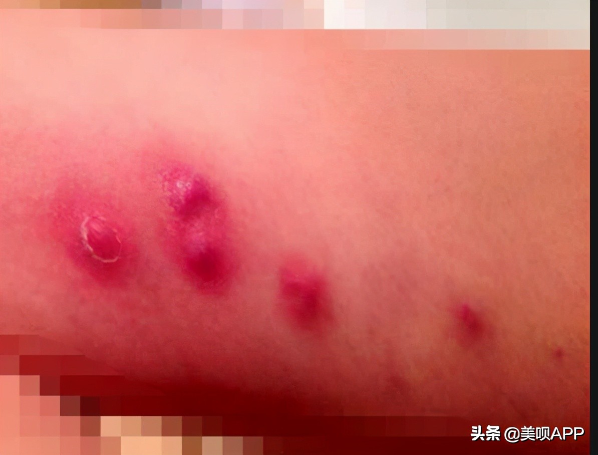 医美避过的坑,医美注射填充常见问题