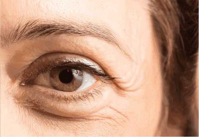 怎样避免眼周长脂肪粒,10%尿素霜可以治疗眼周脂肪粒吗