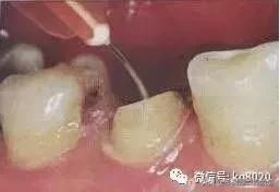 纤维桩的优点和缺点,看完这篇文章就明白了