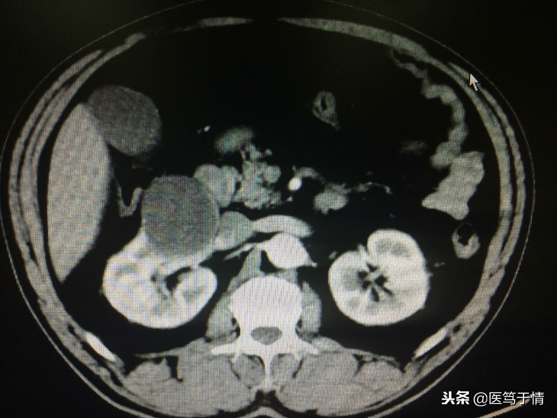肾囊肿10*9mm需要做手术么,肾囊肿14mm用做手术吗