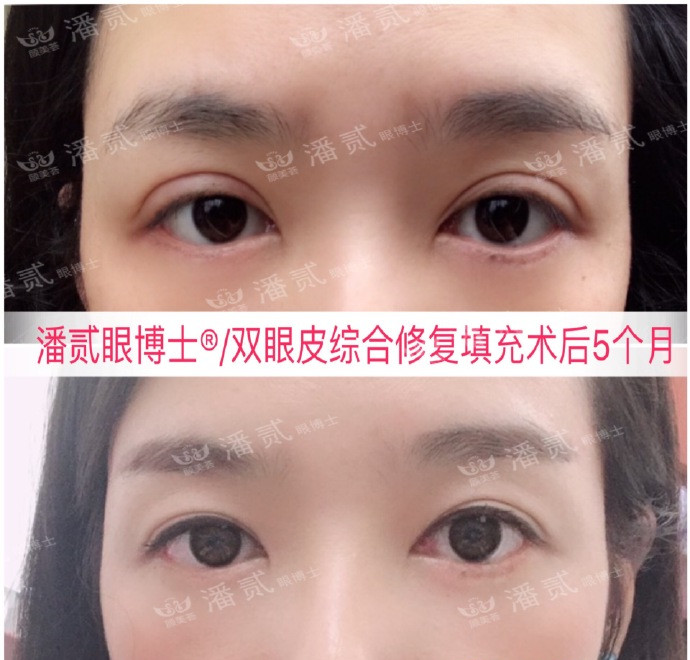 10个工作室做，9个毁，祛眼袋连卧蚕也没了，直接送我到10年后