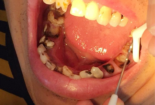 牙齿蛀牙怎么治疗,治疗蛀牙的视频