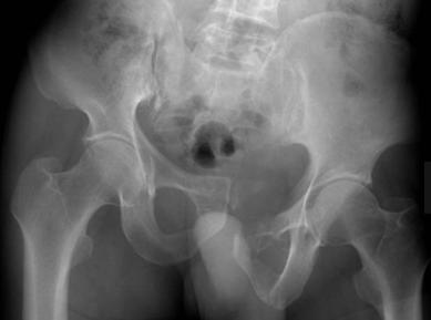 骶髂关节错位表现症状有哪些,骶髂关节错位可以推拿吗