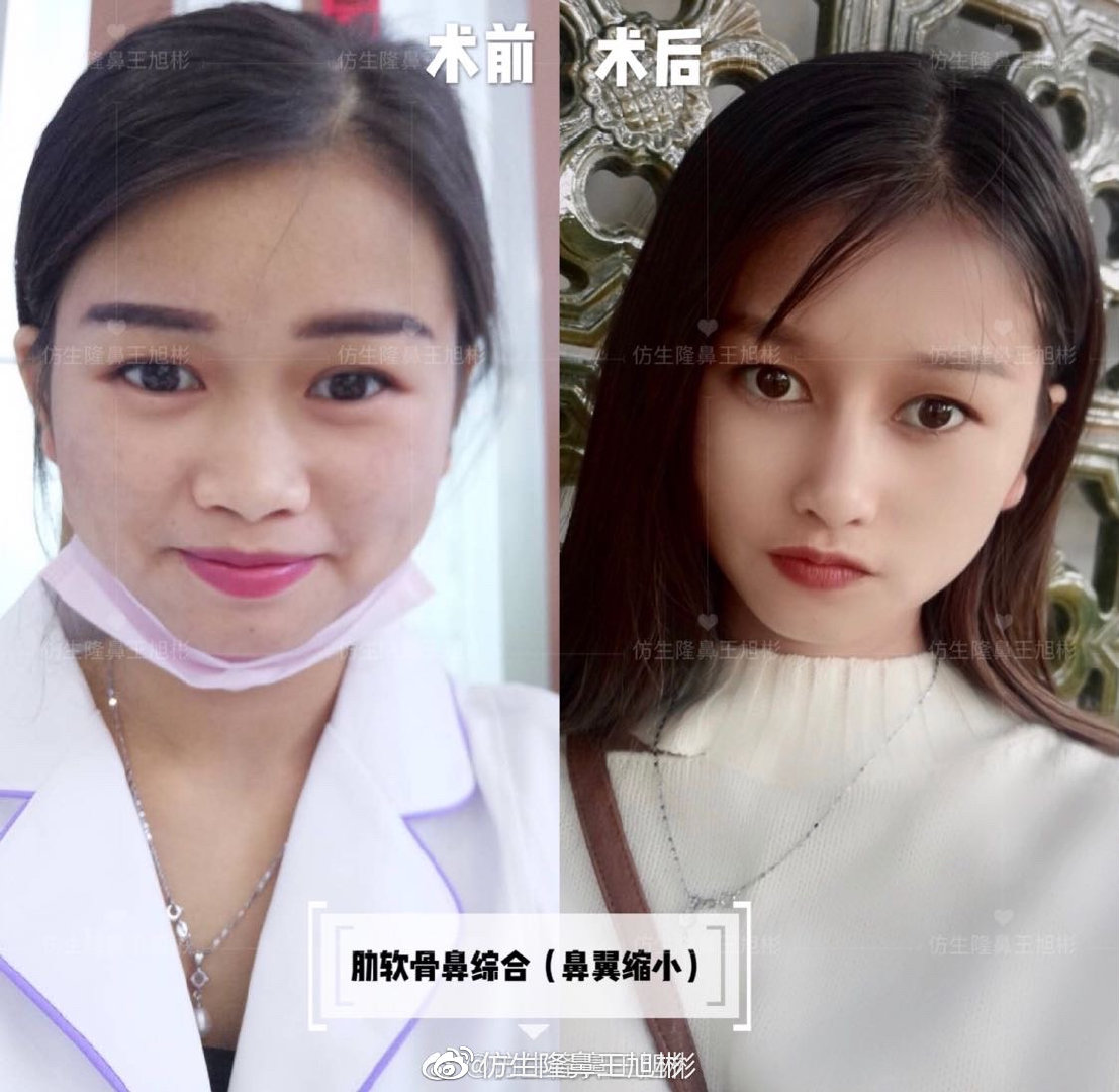 鼻整形最简易方法,鼻孔又大又塌又朝天鼻整形