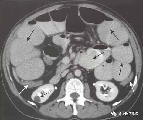 辨识肠梗阻,肠梗阻死亡前兆
