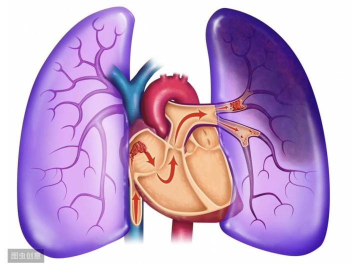 肺栓塞引发的低血压最致命，如何区分是否是肺栓塞引起？