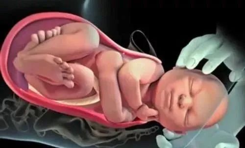 分娩直接剖还是顺转剖好,水下分娩会顺转剖吗