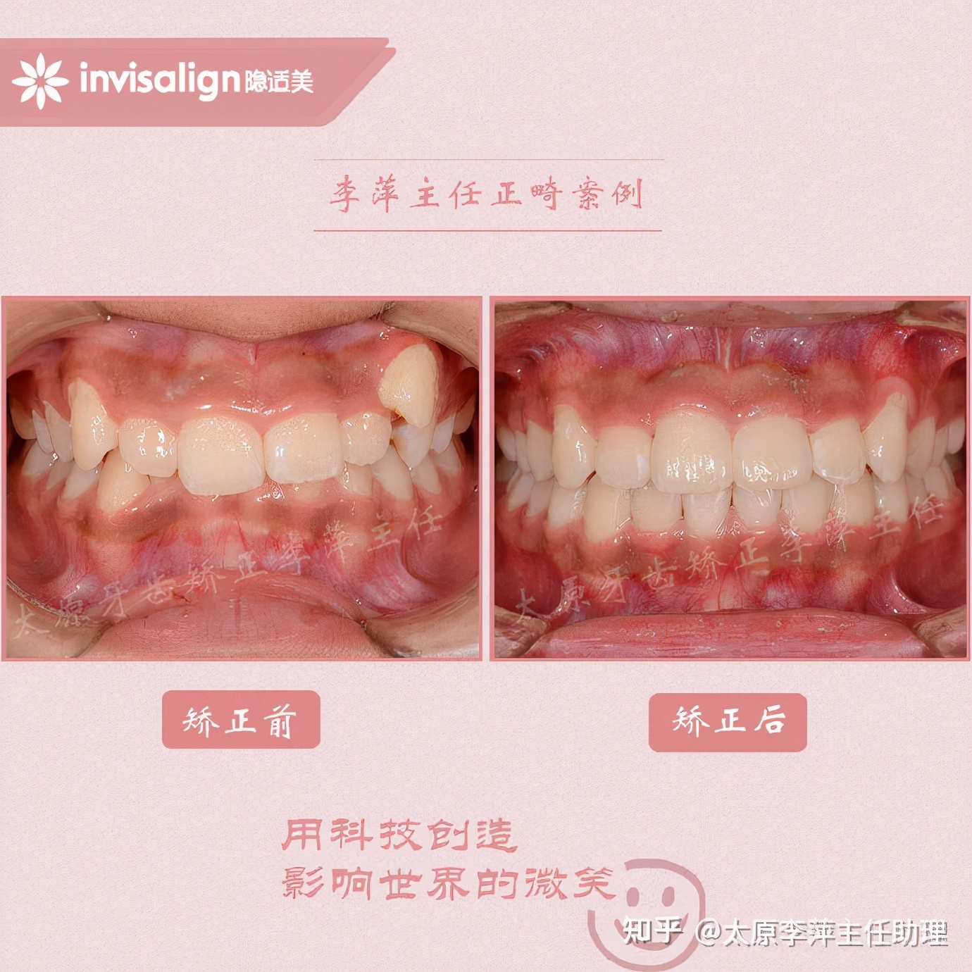 太原牙齿矫正靠谱吗,太原成人隐形牙套牙齿不齐