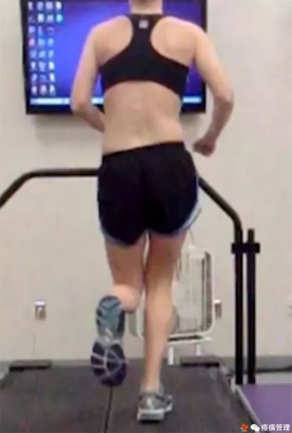走路屁股扭来扭去是种病，还会导致腰痛、脚痛