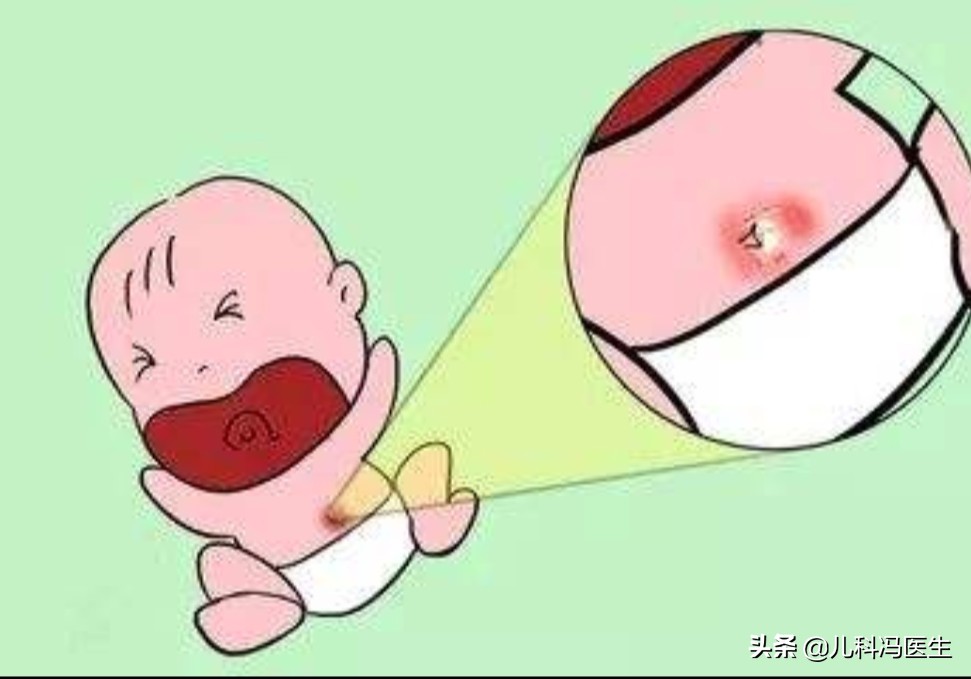 新生儿脐炎首选抗生素,新生儿脐炎症状和表现