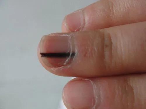 手指甲黑线怎么看是不是黑色素瘤,指甲有甲母痣会癌变吗