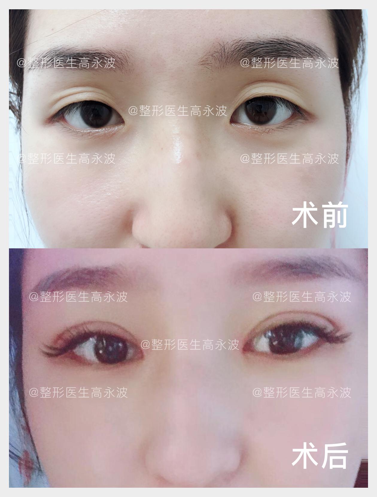 南京双眼皮宽改窄修复案例,韩式双眼皮宽了怎么修复